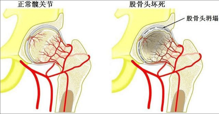 什么是股骨头坏死？股骨头坏死有什么好办法治疗吗？