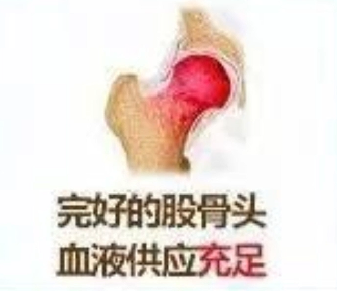 股骨头坏死有什么好办法治疗吗？获得权威认证的中成药优势明显