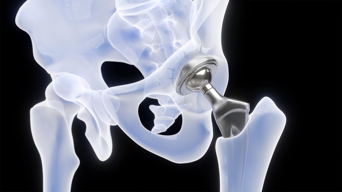 股骨头坏死早期有效治愈方法：中成药展现独特疗效