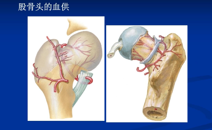 股骨头坏死的保守治疗：找对方法才是关键！