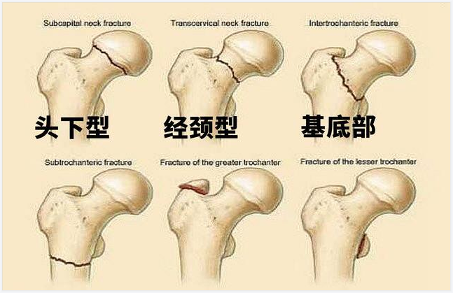 股骨头坏死有什么好办法治疗吗？医学界的攻关成果