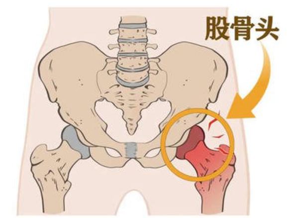 浅谈中医药对于股骨头坏死保守治疗的作用