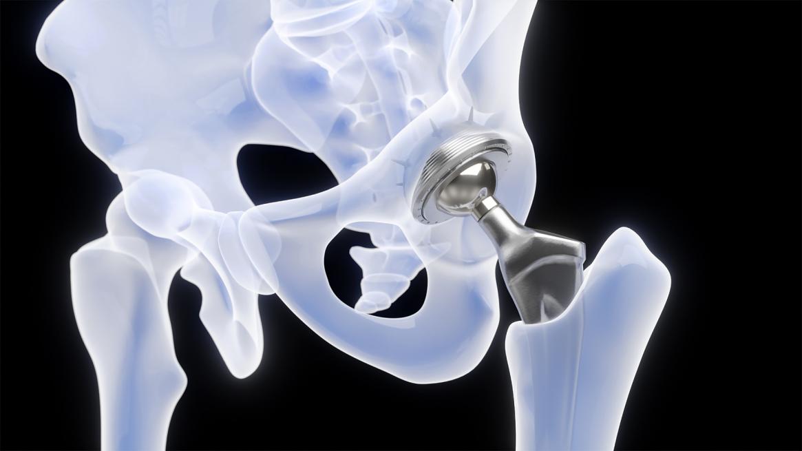 骨科专家共识，中成药可用于股骨头坏死保守治疗！