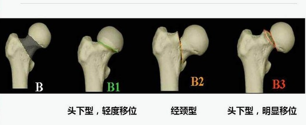 关于股骨头坏死的保守治疗，你还需要知道这些